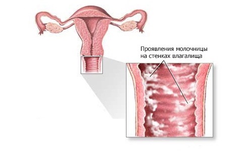 Хронический кандидоз