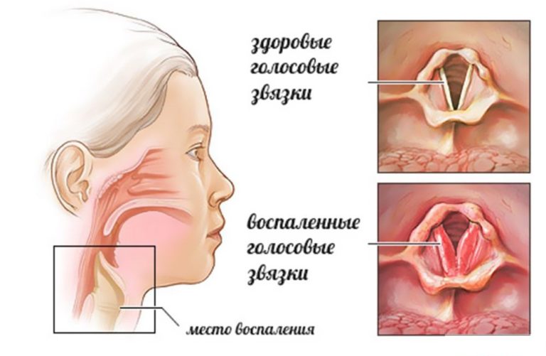 Стенозирующий ларинготрахеит